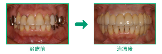審美歯科の治療例2