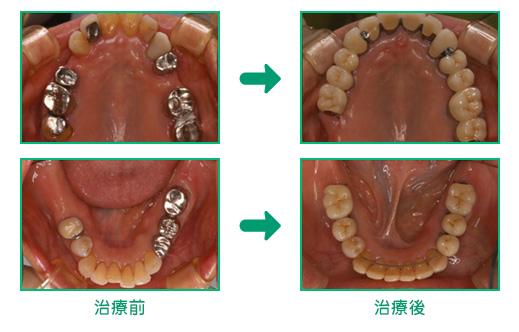 審美歯科の治療例3