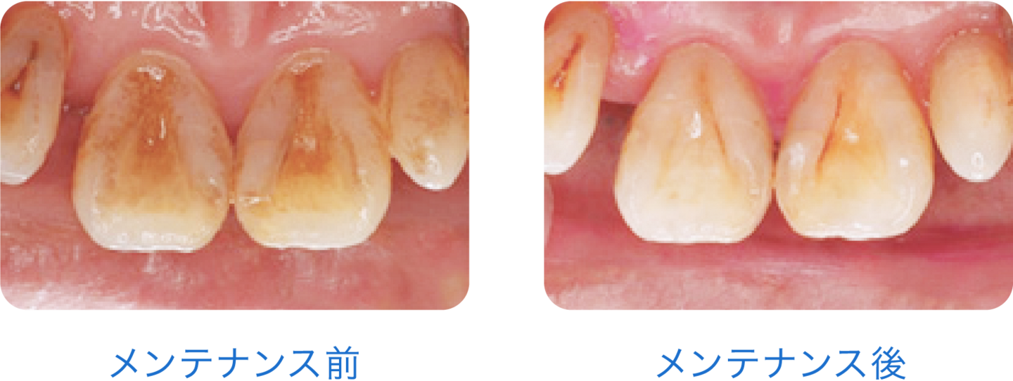 プロフィー_メンテナンス比較画像